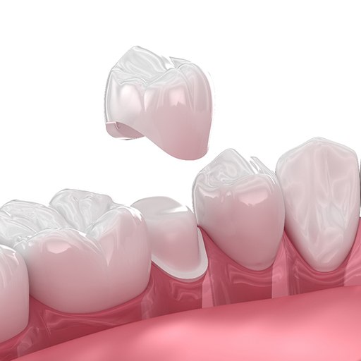 graphic render of a dental crown being placed