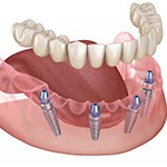 Illustration of All-on-4 dentures