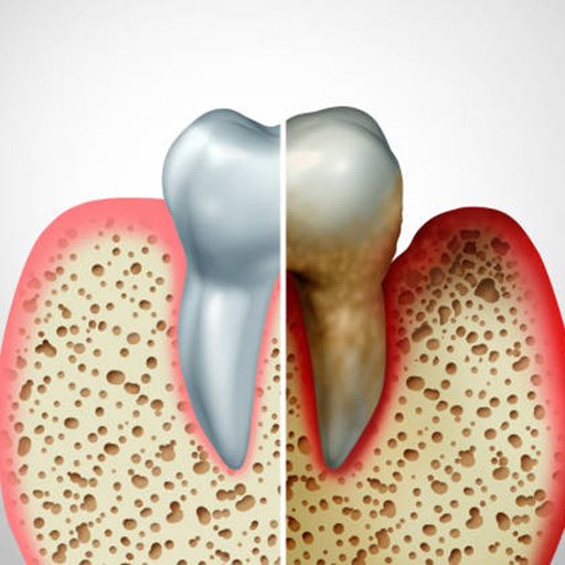 Patient’s mouth with advanced gum disease