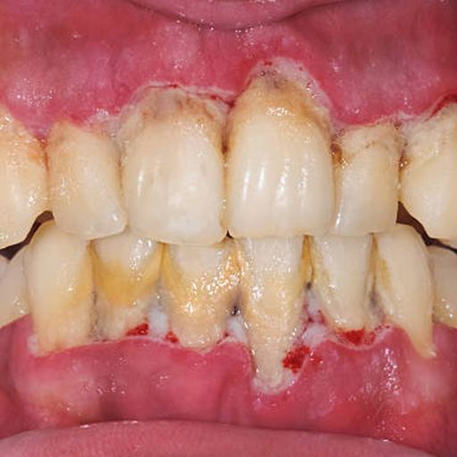 Healthy gums comparison to gum disease