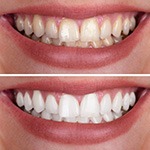 Before and after of a teeth whitening treatment