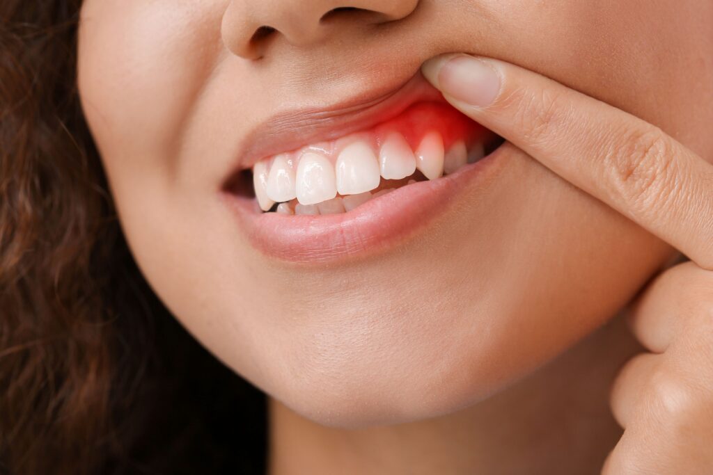 Nose-to-chin view of woman pulling back her lip to reveal inflamed gums